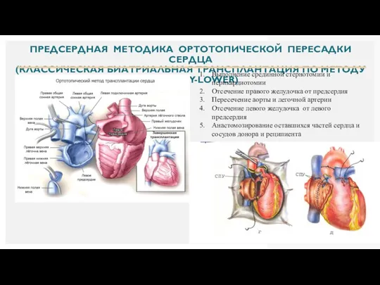 ПРЕДСЕРДНАЯ МЕТОДИКА ОРТОТОПИЧЕСКОЙ ПЕРЕСАДКИ СЕРДЦА (КЛАССИЧЕСКАЯ БИАТРИАЛЬНАЯ ТРАНСПЛАНТАЦИЯ ПО МЕТОДУ SHUMWAY-LOWER)