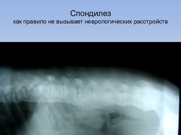 Спондилез как правило не вызывает неврологических расстройств