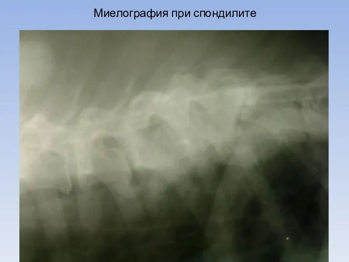 Миелография при спондилите