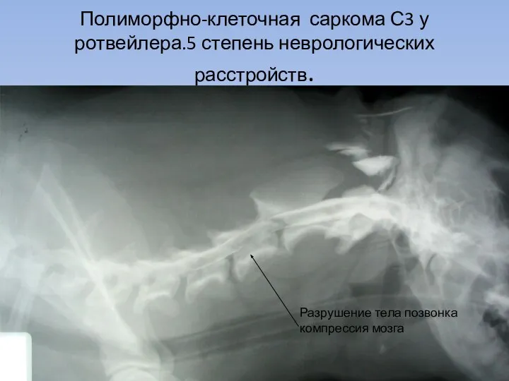 Полиморфно-клеточная саркома С3 у ротвейлера.5 степень неврологических расстройств. Разрушение тела позвонка компрессия мозга