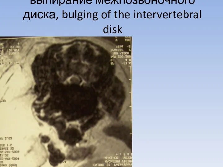 выпирание межпозвоночного диска, bulging of the intervertebral disk