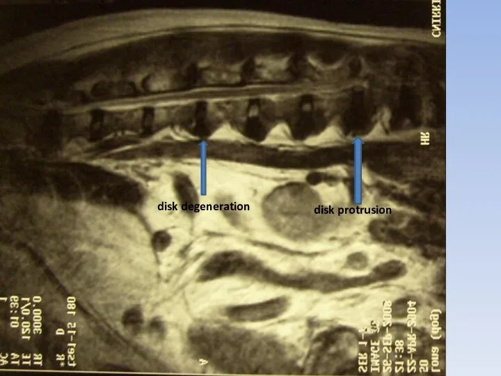 disk protrusion disk degeneration