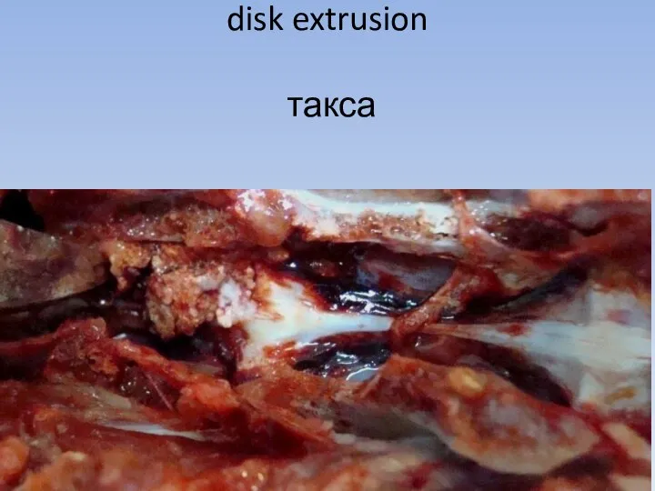 disk extrusion такса