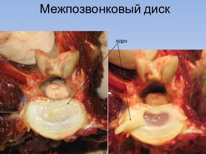 Межпозвонковый диск ядро
