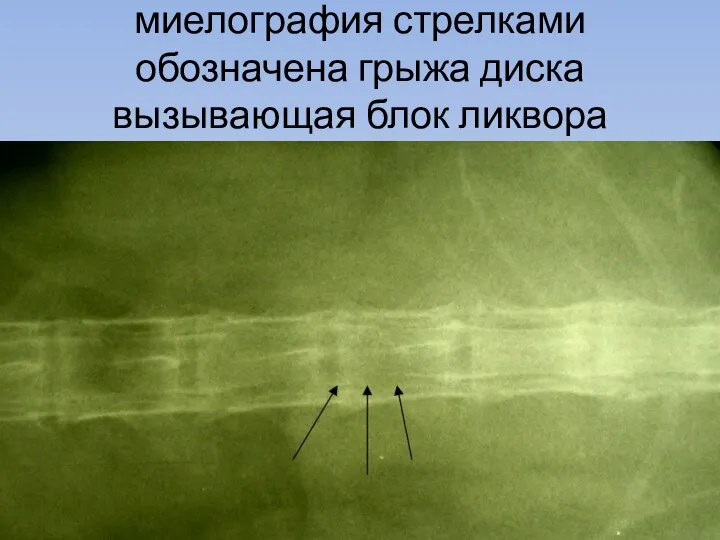 миелография стрелками обозначена грыжа диска вызывающая блок ликвора