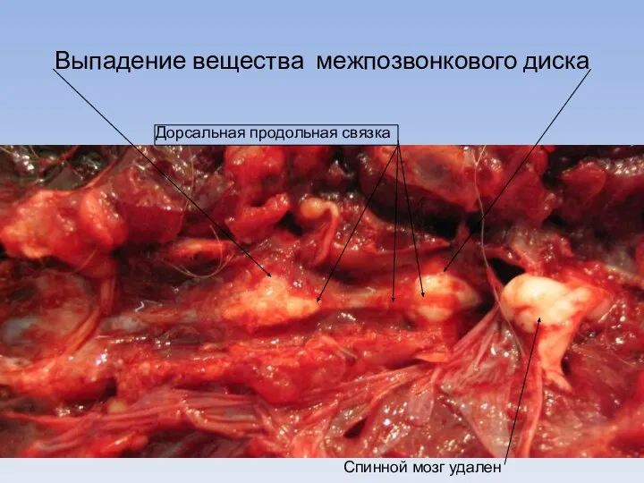 Выпадение вещества межпозвонкового диска Дорсальная продольная связка Спинной мозг удален