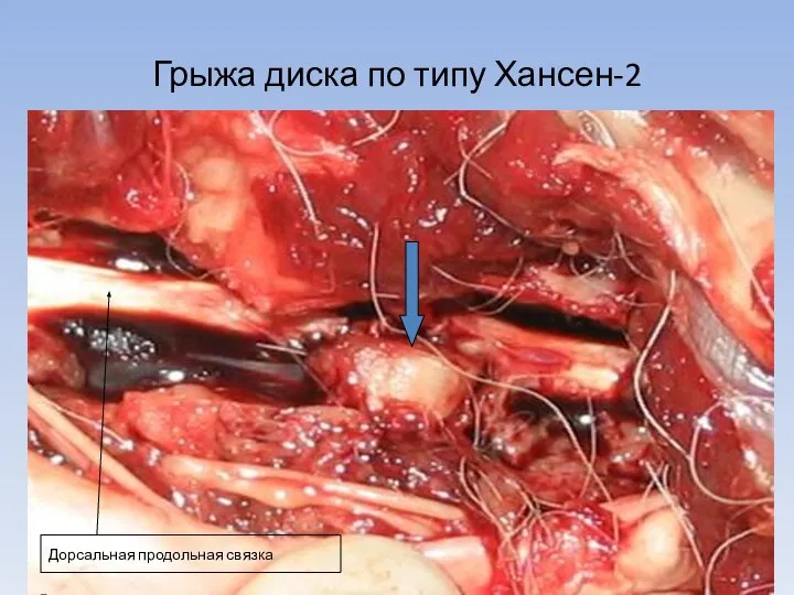 Грыжа диска по типу Хансен-2 Дорсальная продольная связка