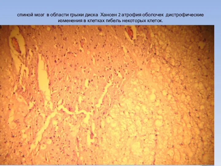 спиной мозг в области грыжи диска Хансен 2 атрофия оболочек дистрофические