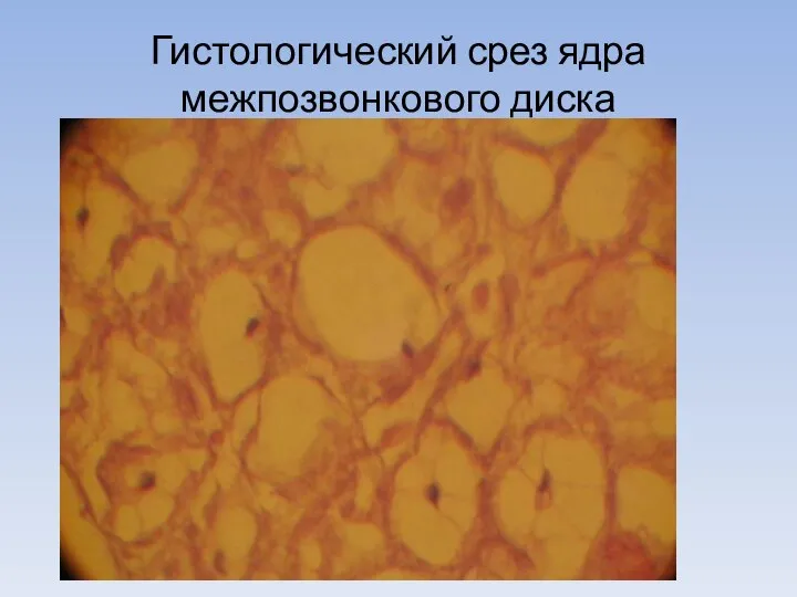 Гистологический срез ядра межпозвонкового диска