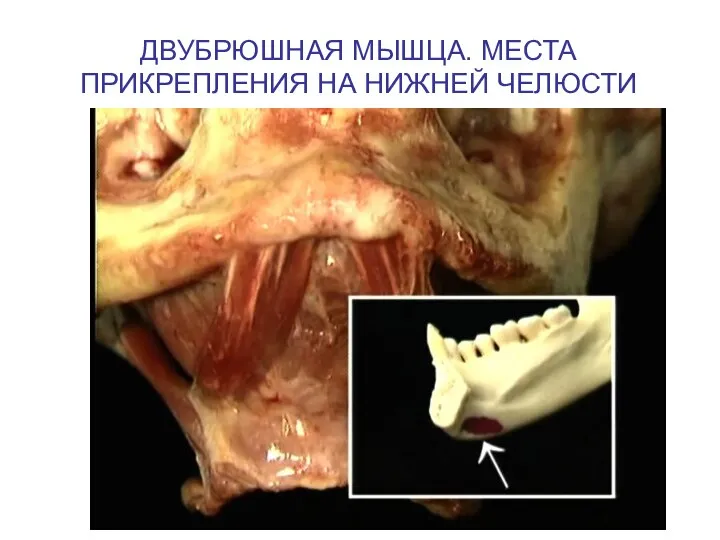 ДВУБРЮШНАЯ МЫШЦА. МЕСТА ПРИКРЕПЛЕНИЯ НА НИЖНЕЙ ЧЕЛЮСТИ