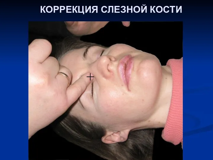 КОРРЕКЦИЯ СЛЕЗНОЙ КОСТИ