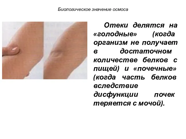 Отеки делятся на «голодные» (когда организм не получает в достаточном количестве