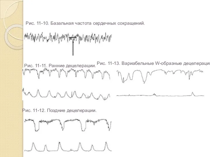 Рис. 11-10. Базальная частота сердечных сокращений. Рис. 11-11. Ранние децелерации. Рис.
