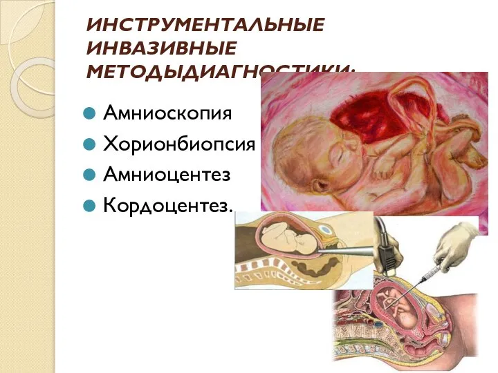 ИНСТРУМЕНТАЛЬНЫЕ ИНВАЗИВНЫЕ МЕТОДЫДИАГНОСТИКИ: Амниоскопия Хорионбиопсия Амниоцентез Кордоцентез.