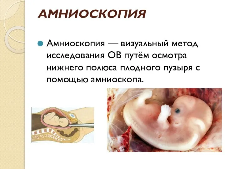 АМНИОСКОПИЯ Амниоскопия — визуальный метод исследования ОВ путём осмотра нижнего полюса плодного пузыря с помощью амниоскопа.