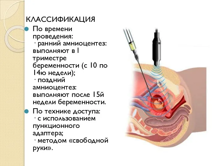 КЛАССИФИКАЦИЯ По времени проведения: · ранний амниоцентез: выполняют в I триместре