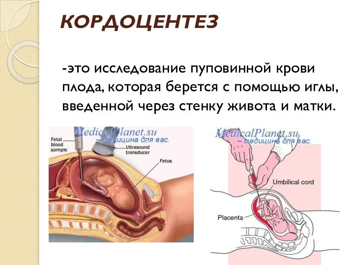 КОРДОЦЕНТЕЗ -это исследование пуповинной крови плода, которая берется с помощью иглы,