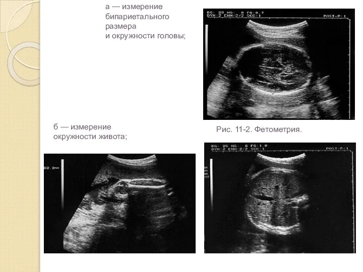 Рис. 11-2. Фетометрия. б — измерение окружности живота; а — измерение бипариетального размера и окружности головы;
