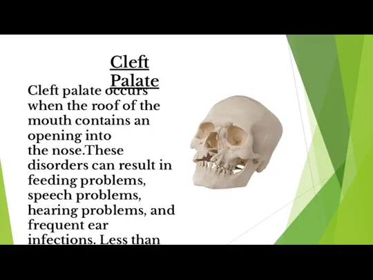 Cleft Palate Cleft palate occurs when the roof of the mouth