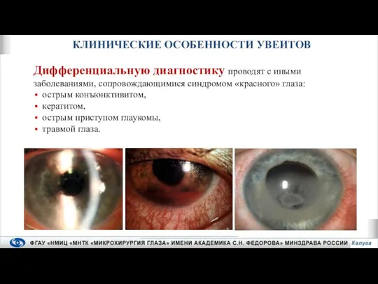 Дифференциальную диагностику проводят с иными заболеваниями, сопровождающимися синдромом «красного» глаза: острым