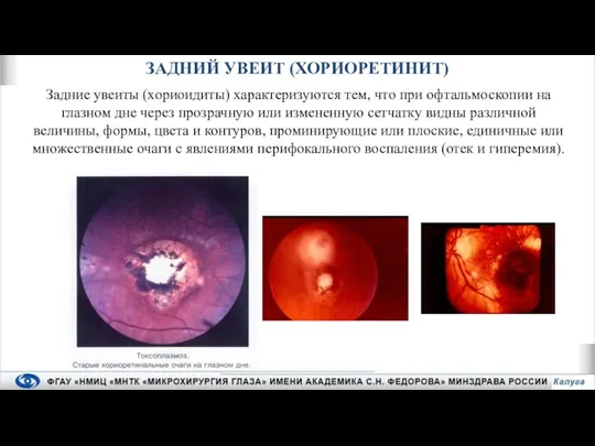 Задние увеиты (хориоидиты) характеризуются тем, что при офтальмоскопии на глазном дне