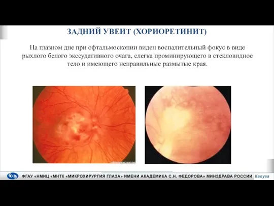 На глазном дне при офтальмоскопии виден воспалительный фокус в виде рыхлого