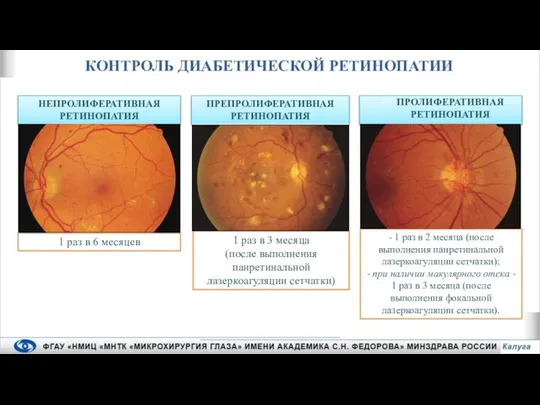 ПРОЛИФЕРАТИВНАЯ РЕТИНОПАТИЯ КОНТРОЛЬ ДИАБЕТИЧЕСКОЙ РЕТИНОПАТИИ НЕПРОЛИФЕРАТИВНАЯ РЕТИНОПАТИЯ ПРЕПРОЛИФЕРАТИВНАЯ РЕТИНОПАТИЯ 1 раз