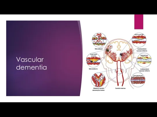 Vascular dementia