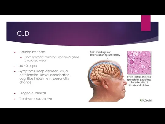 CJD Caused by prions From sporadic mutation, abnormal gene, uncooked meat