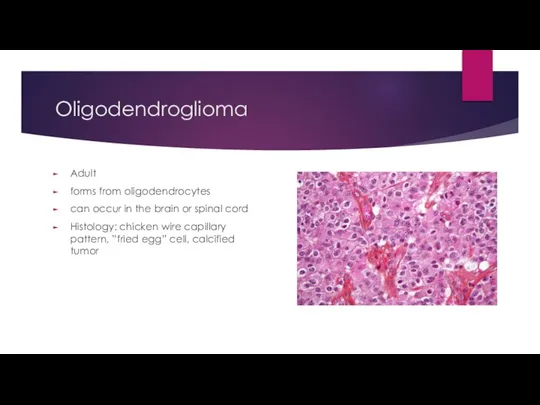 Oligodendroglioma Adult forms from oligodendrocytes can occur in the brain or