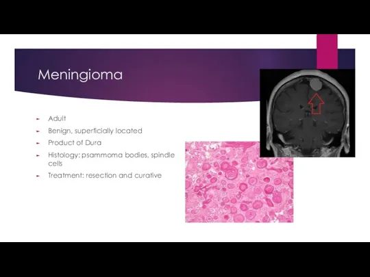 Meningioma Adult Benign, superficially located Product of Dura Histology: psammoma bodies,