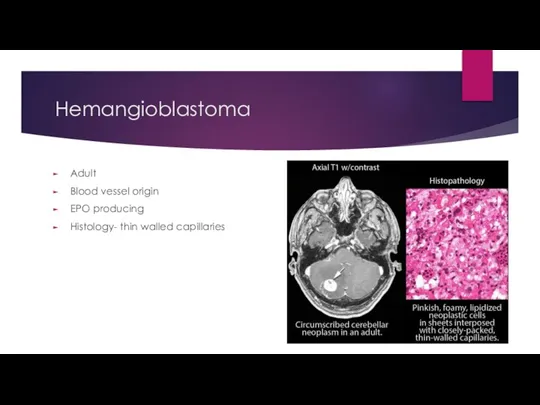 Hemangioblastoma Adult Blood vessel origin EPO producing Histology- thin walled capillaries