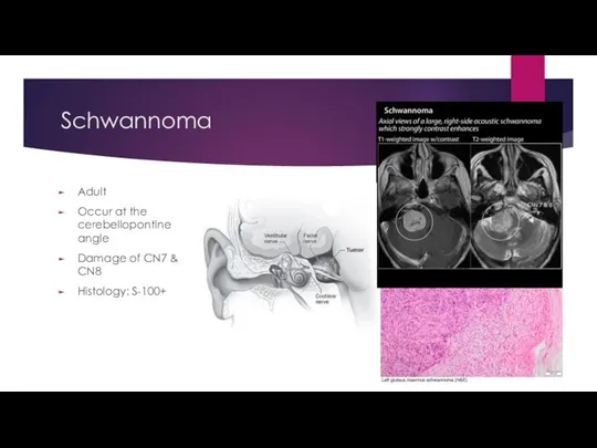 Schwannoma Adult Occur at the cerebellopontine angle Damage of CN7 & CN8 Histology: S-100+