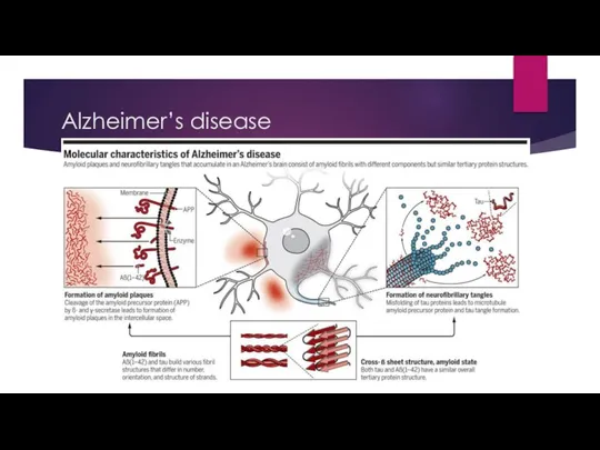 Alzheimer’s disease