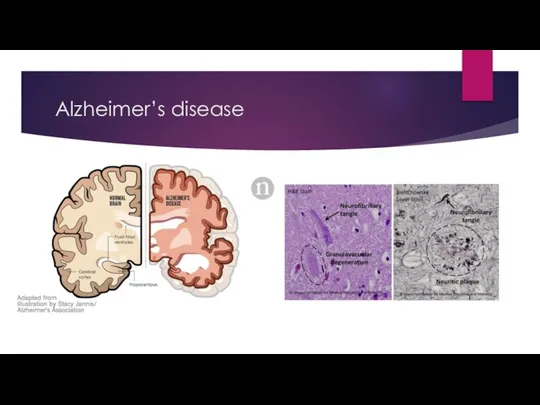 Alzheimer’s disease