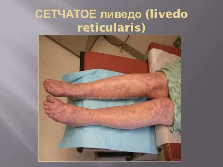 СЕТЧАТОЕ ливедо (livedo reticularis)