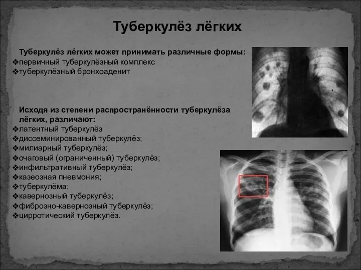 Туберкулёз лёгких Туберкулёз лёгких может принимать различные формы: первичный туберкулёзный комплекс