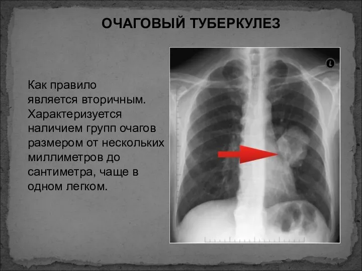 ОЧАГОВЫЙ ТУБЕРКУЛЕЗ Как правило является вторичным. Характеризуется наличием групп очагов размером