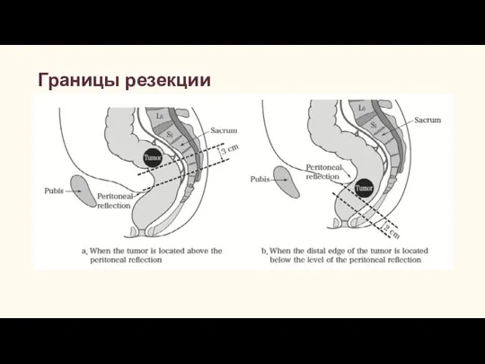 Границы резекции