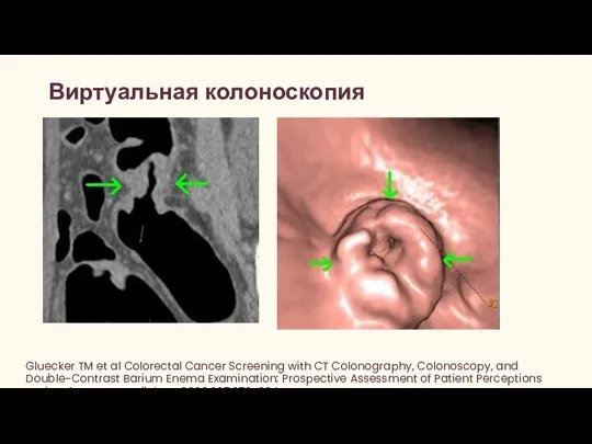 Виртуальная колоноскопия Gluecker TM et al Colorectal Cancer Screening with CT