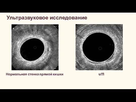 Ультразвуковое исследование Нормальная стенка прямой кишки uT1