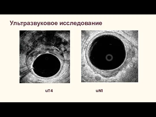 Ультразвуковое исследование uT4 uN1