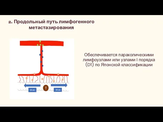 2. Продольный путь лимфогенного метастазирования Обеспечивается параколическими лимфоузлами или узлами I порядка(D1) по Японской классификации