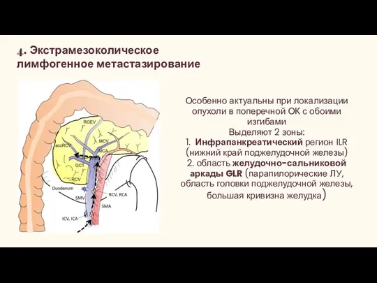 4. Экстрамезоколическое лимфогенное метастазирование Особенно актуальны при локализации опухоли в поперечной