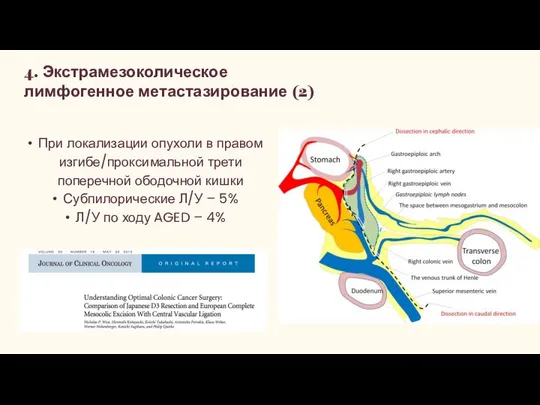 4. Экстрамезоколическое лимфогенное метастазирование (2) При локализации опухоли в правом изгибе/проксимальной