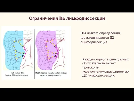 Ограничения D2 лимфодиссекции Нет четкого определения, где заканчивается Д2 лимфодиссекция Каждый