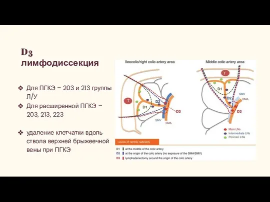 D3 лимфодиссекция Для ПГКЭ – 203 и 213 группы Л/У Для