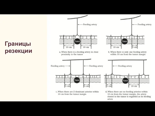 Границы резекции