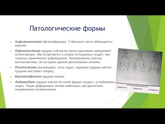 Патологические формы Эмфизематозная (бочкообразная). У больного часто наблюдается одышка. Паралитическая грудная