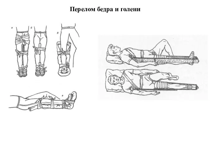 Перелом бедра и голени